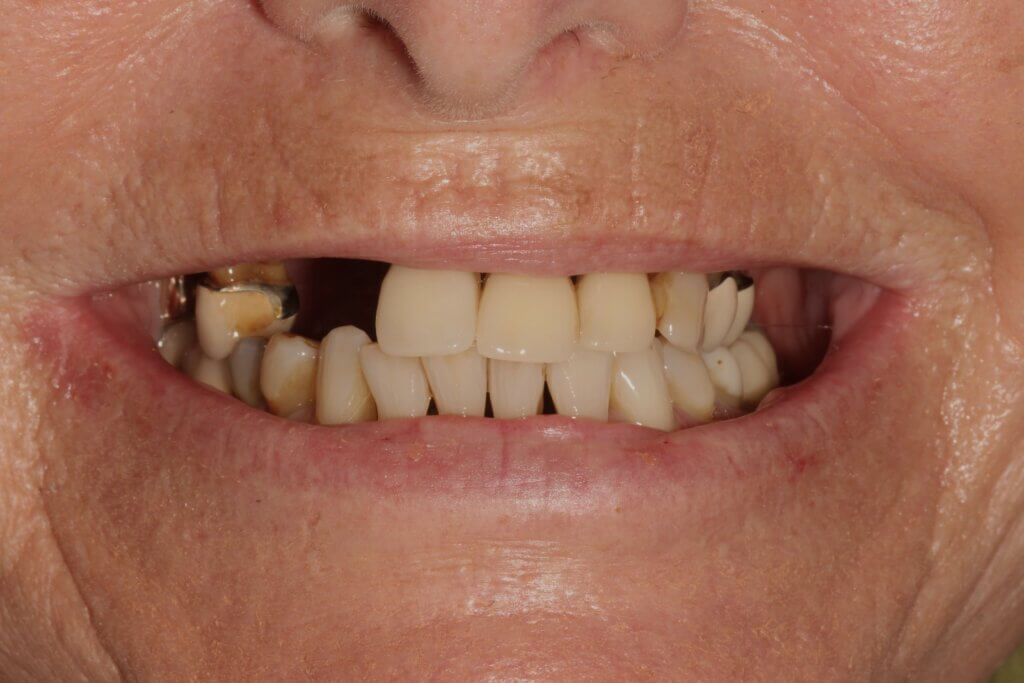 Behandlung Feste Zähne an einem Tag