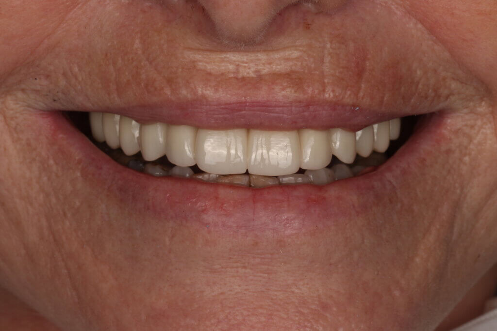 Eingesetzter Zahnersatz