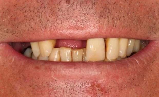 Ausgangssituation vor der Implantatbehandlung trotz Knochenschwund