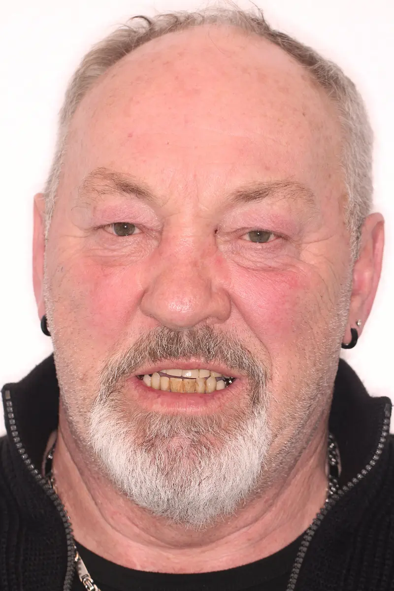 Gerhard Portrait vor der Behandlung
