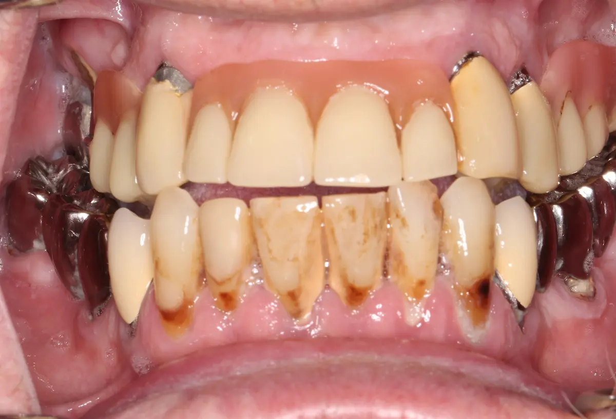 Gerhard intraoral vor der Behandlung