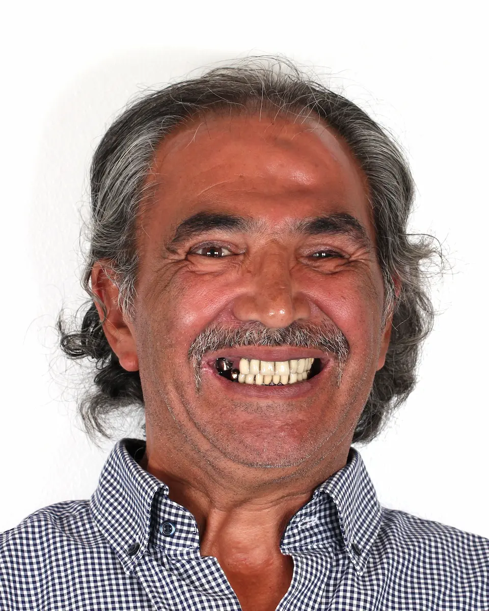 Cemil Portrait vor der Behandlung