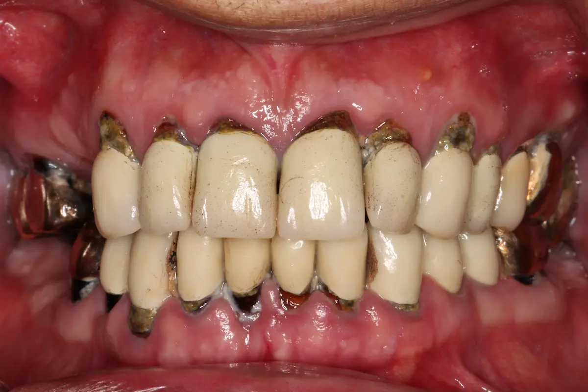 Cemil intraoral vor der Behandlung